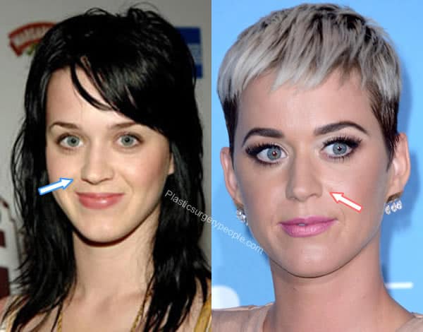Katy Perry nose job before and after