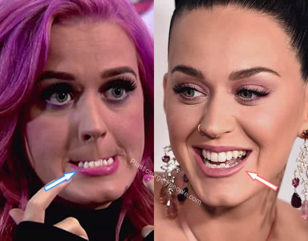 Katy Perry teeth before and after