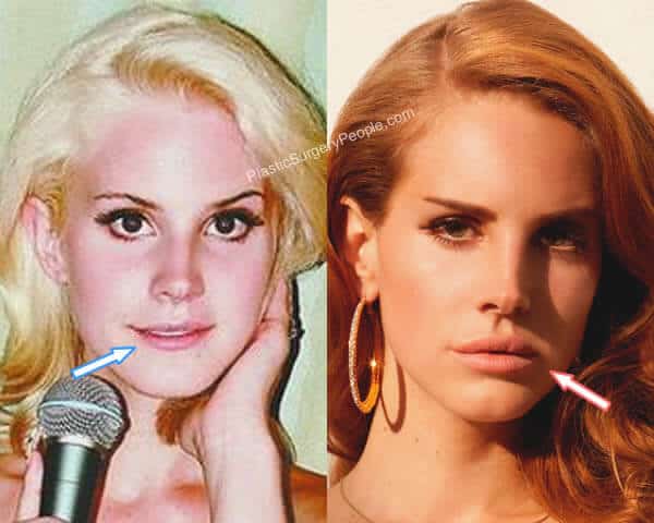 Lana Del Rey lip injections before and after