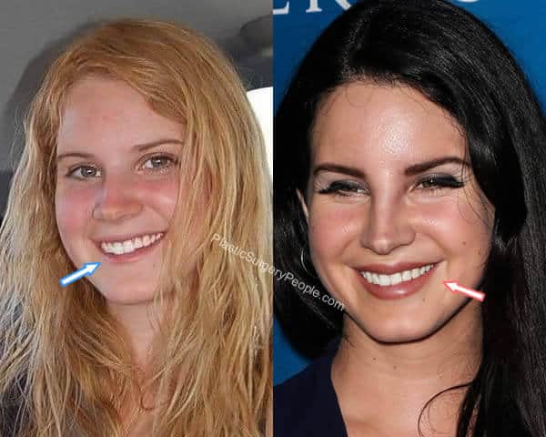 Lana Del Rey teeth before and after
