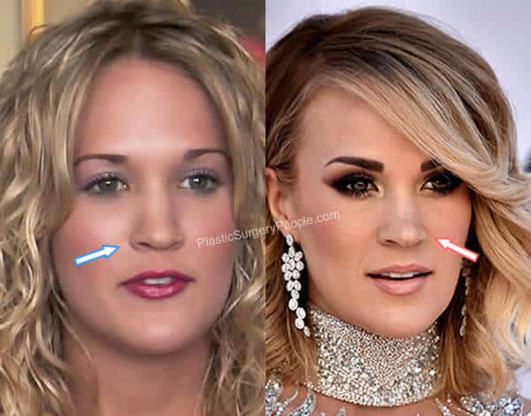 Carrie Underwood nose job before and after?