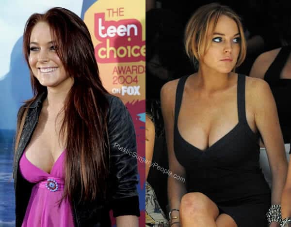 Lindsay Lohan boob job before and after?
