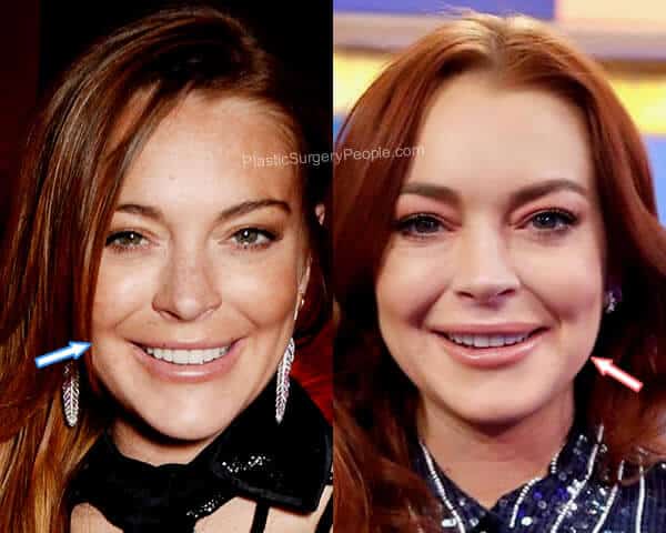 Lindsay Lohan botox before and after?
