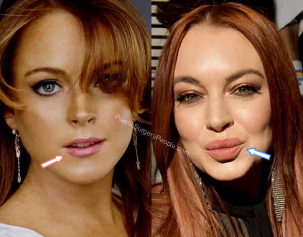 Lindsay Lohan lip injections before and after?