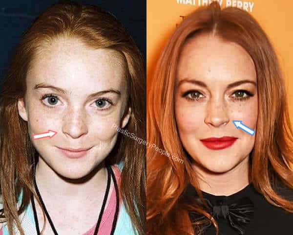Lindsay Lohan nose job before and after?