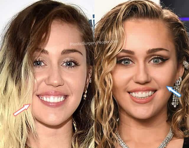 Miley Cyrus Botox Before and After