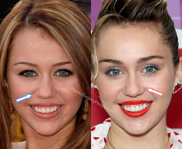 Miley Cyrus Nose Job Before and After