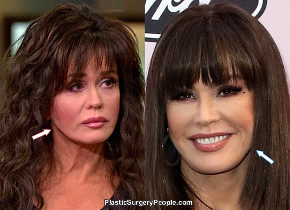 Marie Osmond BEFORE and AFTER 2020