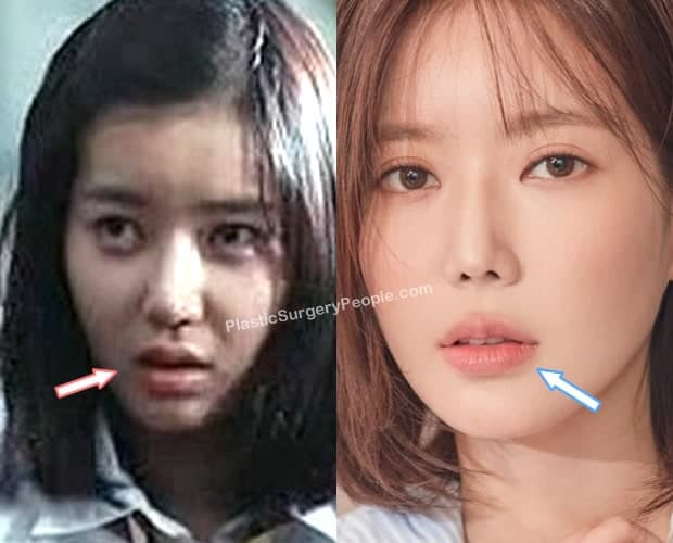 Did Im Soo Hyang get lip fillers?
