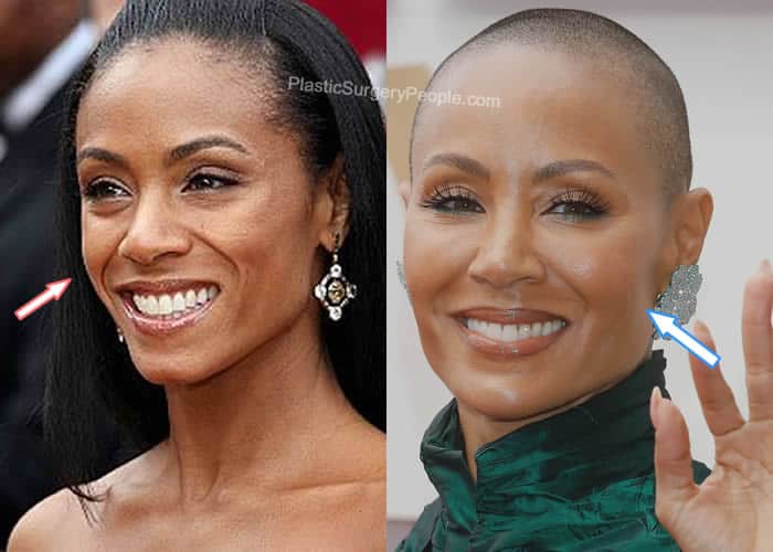 Jada Pinkett Smith cheek implants before and after photo