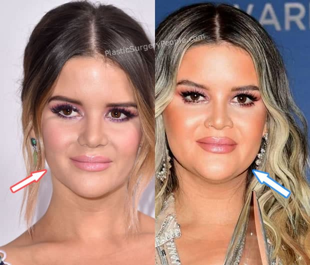 Maren Morris botox before and after