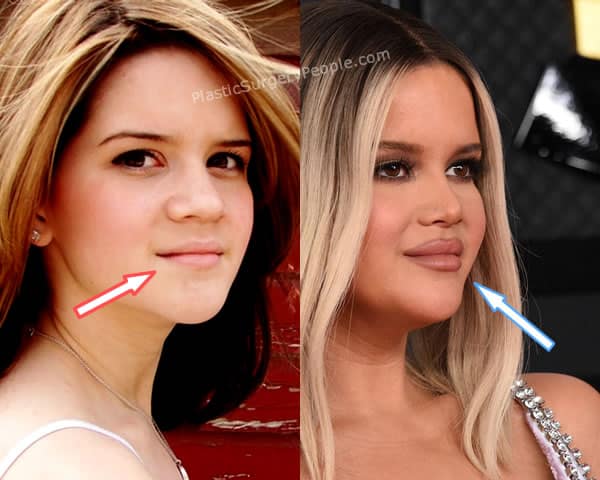Maren Morris lip fillers before and after