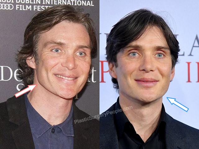 Cillian Murphy botox before and after photo