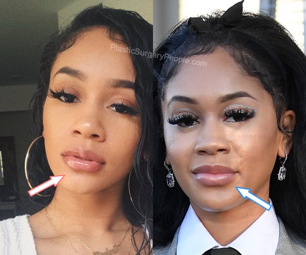 Saweetie lip fillers before and after photo