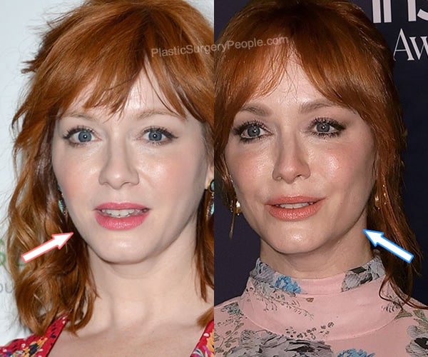 Christina Hendricks botox before and after photo