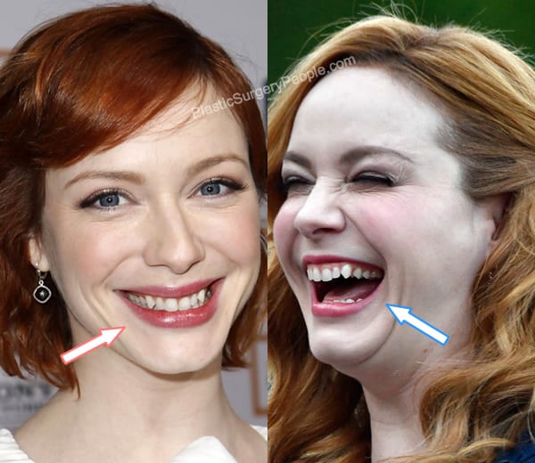 Christina Hendricks teeth before and after photo