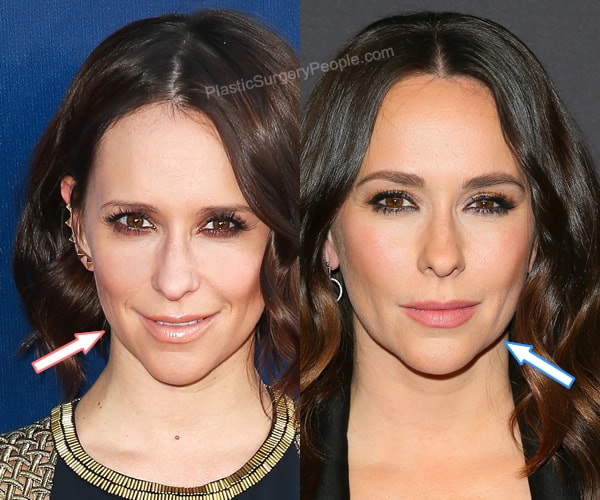 Jennifer Love Hewitt facelift before and after photo