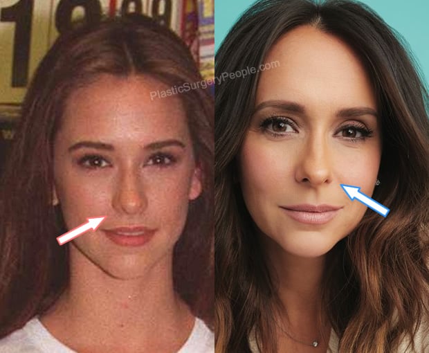 Jennifer Love Hewitt nose job before and after photo