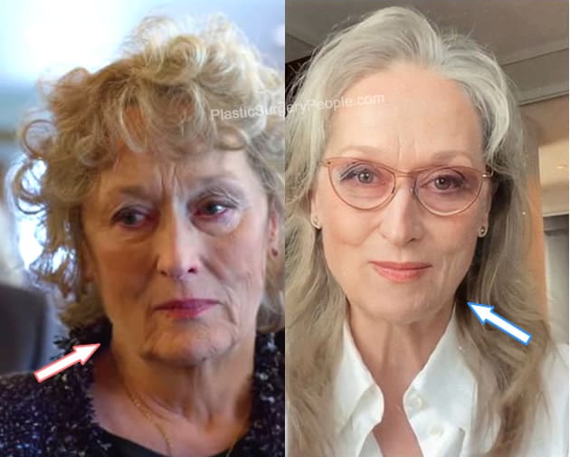 Meryl Streep facelift before and after photo