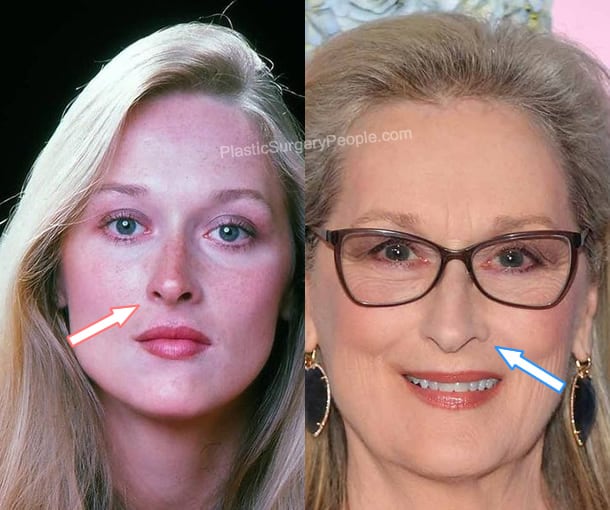 Meryl Streep nose job before and after photo
