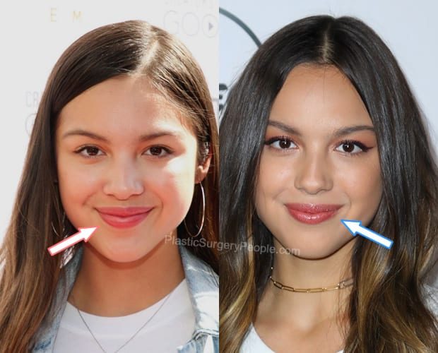 Olivia Rodrigo lip injections before and after photo