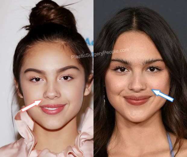 Olivia Rodrigo nose job before and after photo