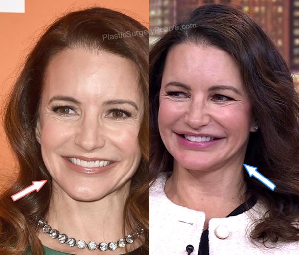 Kristin Davis botox before and after photo