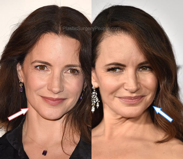 Kristin Davis facelift before and after photo