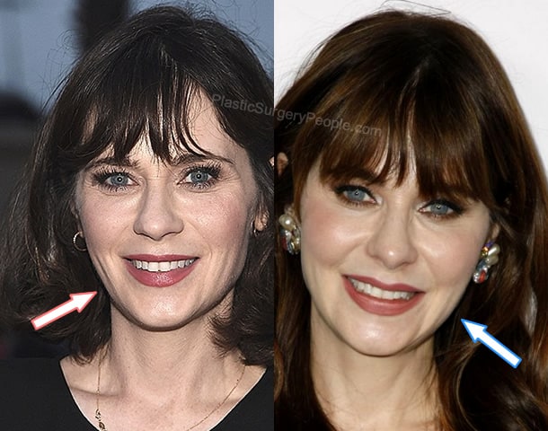 Zooey Deschanel botox before and after photo