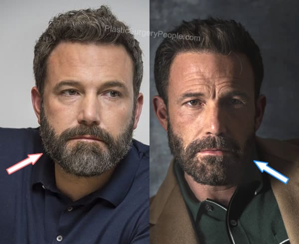 Ben Affleck facelift before and after photo