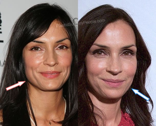 Famke Janssen botox before and after photo comparison