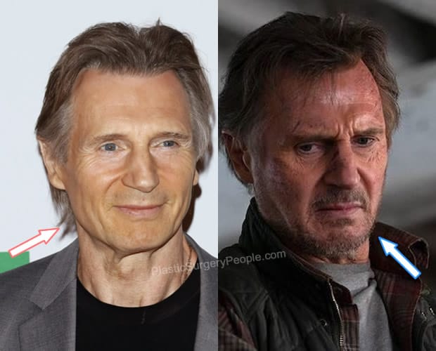 Liam Neeson botox before and after photo