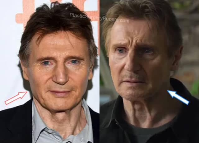 Liam Neeson facelift before and after photo