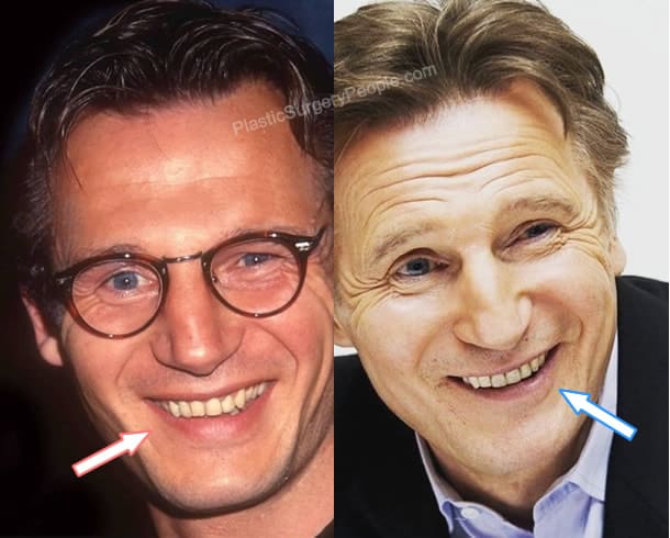 Liam Neeson teeth before and after photo