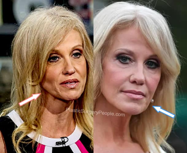 Kellyanne Conway botox before and after photo comparison