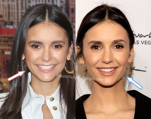 Nina Dobrev botox before and after photo