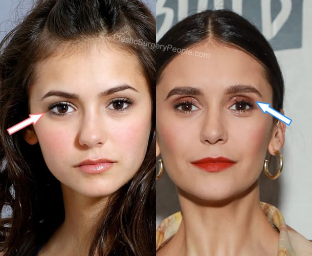 Nina Dobrev eyelid surgery before and after photo