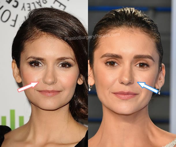 Nina Dobrev nose job before and after photo