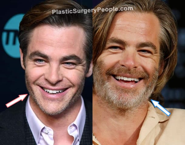 Chris Pine botox before and after photo