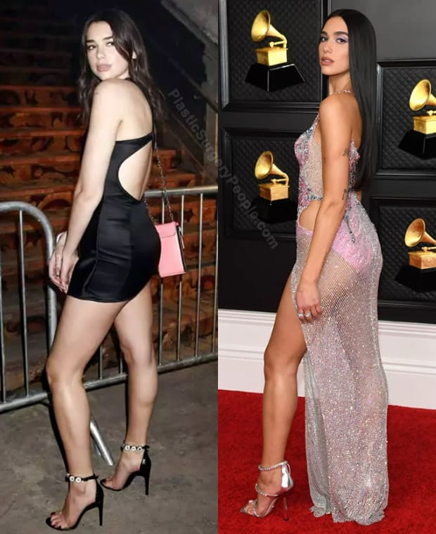 Dua Lipa butt lift before and after photo