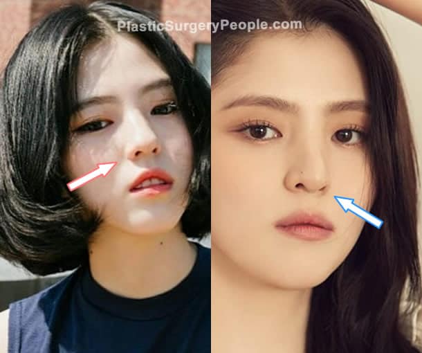 Han So Hee nose job before and after photo