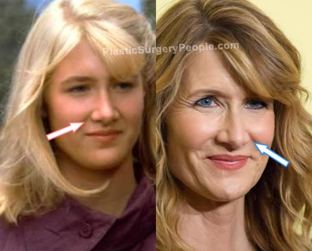 Laura Dern nose job before and after photo
