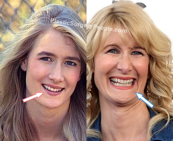 Laura Dern teeth before and after photo