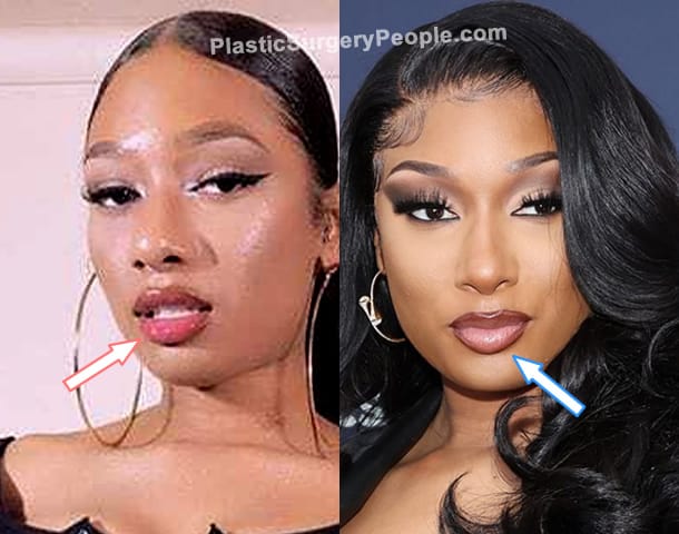 Megan Thee Stallion lip injections before and after photo