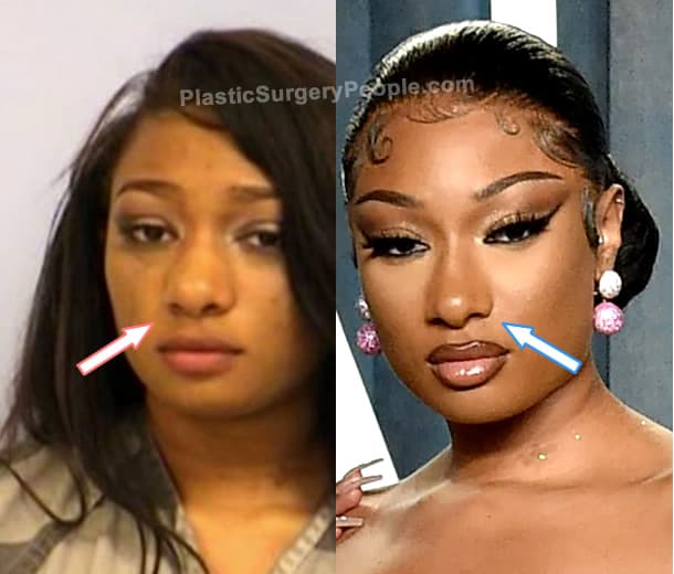 Megan Thee Stallion nose job before and after photo