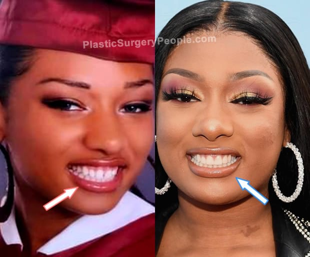 Megan Thee Stallion teeth before and after photo