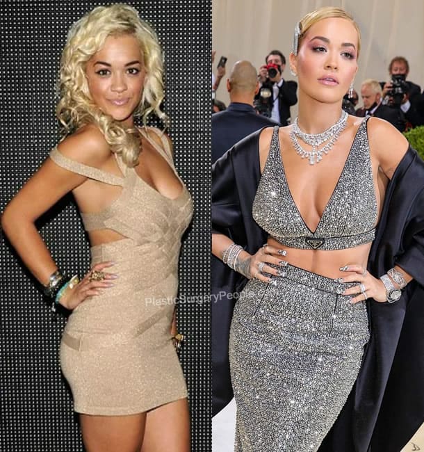 Rita Ora boob job before and after photo