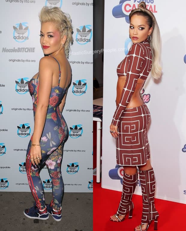 Rita Ora butt lift before and after photo