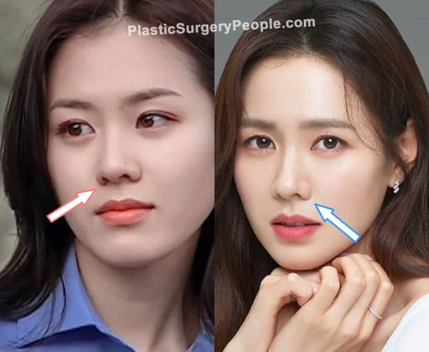 Son Ye Jin nose job before and after photo
