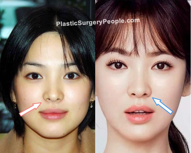 Song Hye Kyo nose job before and after photo